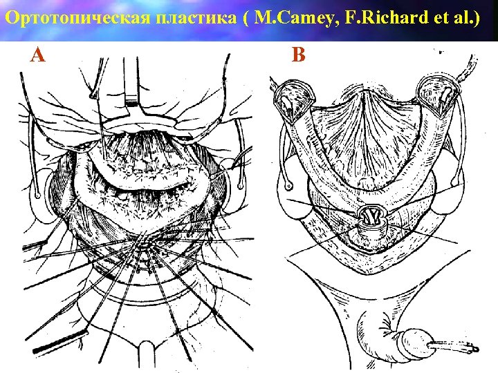 Ортотопическая пластика ( M. Camey, F. Richard et al. ) A B 