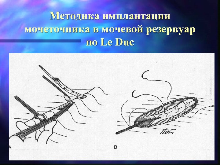 Методика имплантации мочеточника в мочевой резервуар по Le Duc 