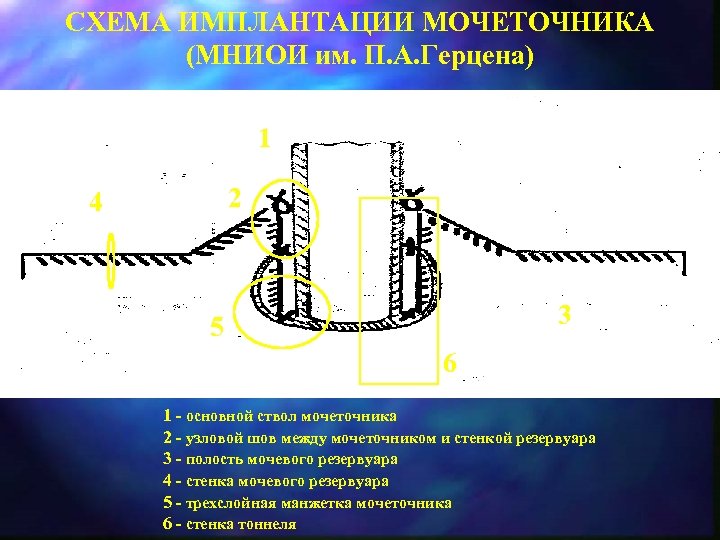 СХЕМА ИМПЛАНТАЦИИ МОЧЕТОЧНИКА (МНИОИ им. П. А. Герцена) 1 2 4 3 5 6