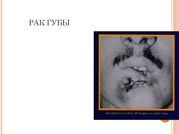 РАК ГУБЫ 