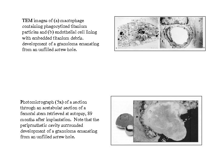 TEM images of (a) macrophage containing phagocytized titanium particles and (b) endothelial cell lining