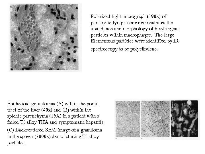 Polarized light micrograph (190 x) of paraaortic lymph node demonstrates the abundance and morphology