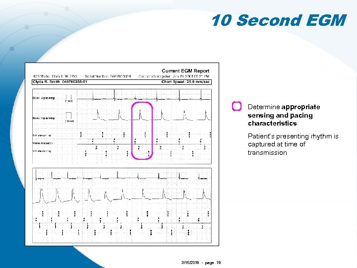 10 Second EGM Determine appropriate sensing and pacing characteristics Patient’s presenting rhythm is captured