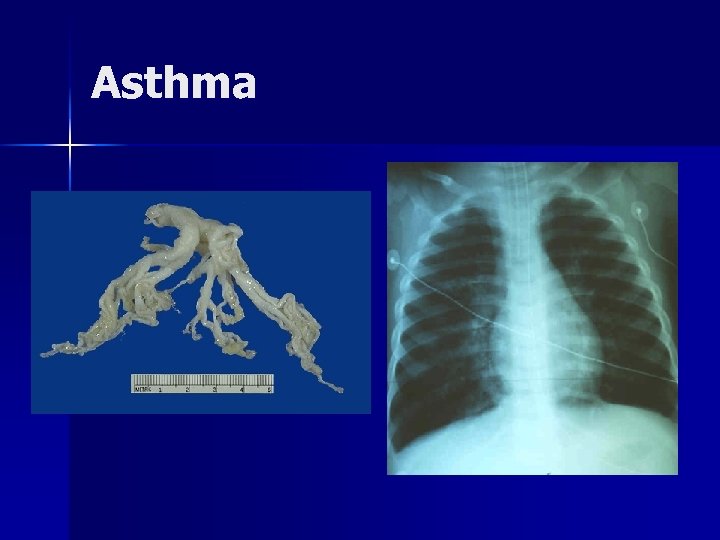 Asthma 