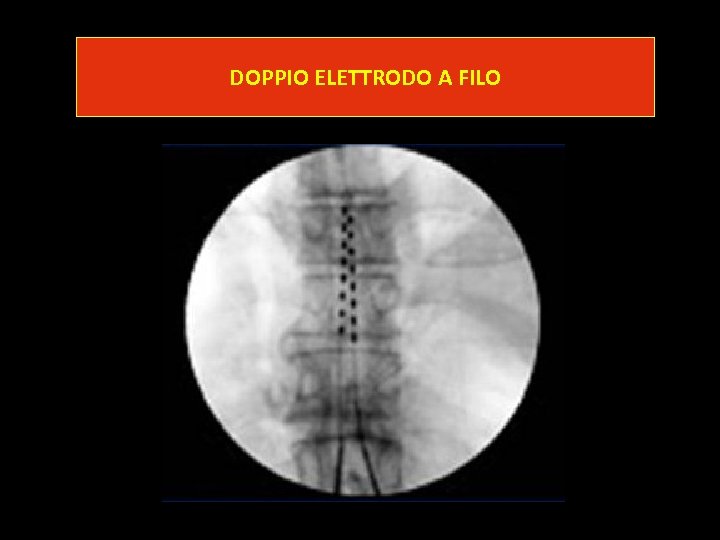 DOPPIO ELETTRODO A FILO 