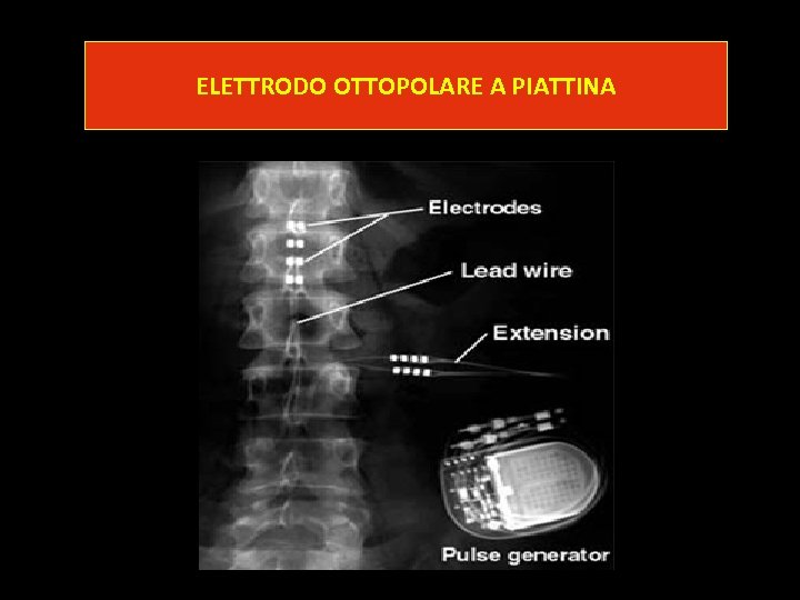 ELETTRODO OTTOPOLARE A PIATTINA 