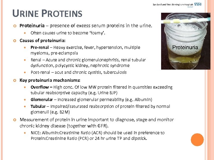 URINE PROTEINS Proteinuria – presence of excess serum proteins in the urine. Often causes