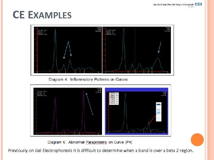 CE EXAMPLES Previously on Gel Electrophoresis it is difficult to determine when a band