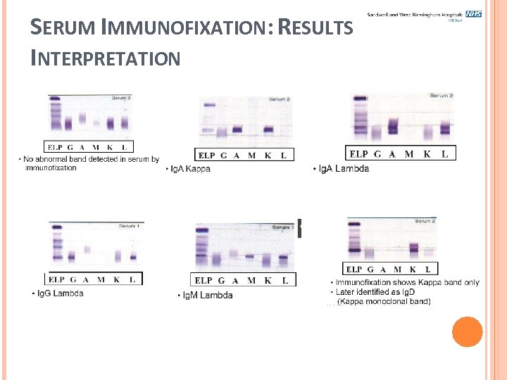 SERUM IMMUNOFIXATION: RESULTS INTERPRETATION 