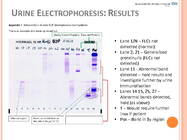 URINE ELECTROPHORESIS: RESULTS • Lane 1/N – FLCs not detected (normal) • Lane 2,