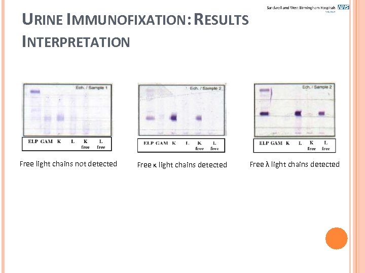 URINE IMMUNOFIXATION: RESULTS INTERPRETATION Free light chains not detected Free κ light chains detected