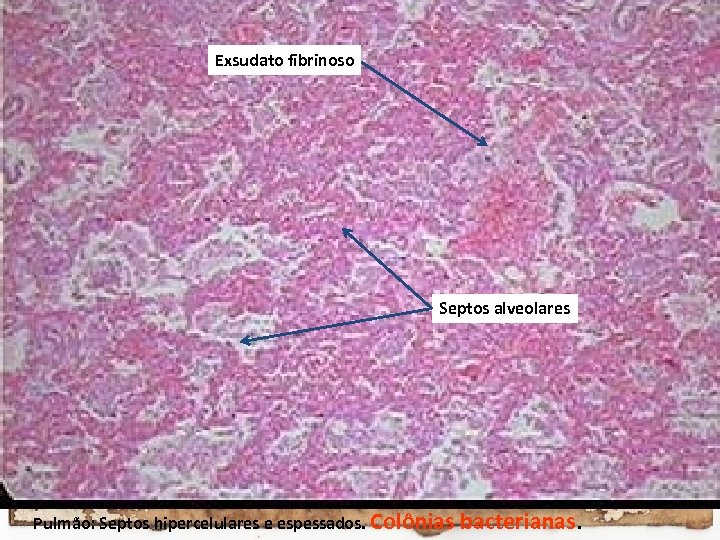 Exsudato fibrinoso Septos alveolares Pulmão: Septos hipercelulares e espessados. Colônias bacterianas. 