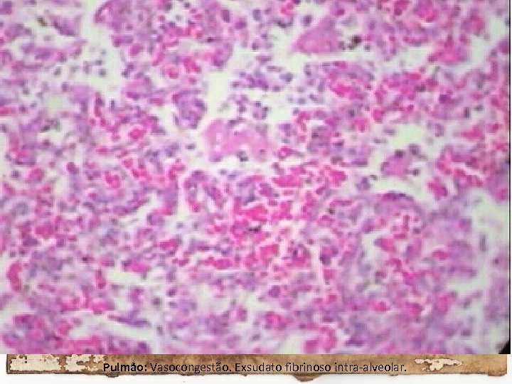Pulmão: Vasocongestão. Exsudato fibrinoso intra-alveolar. 