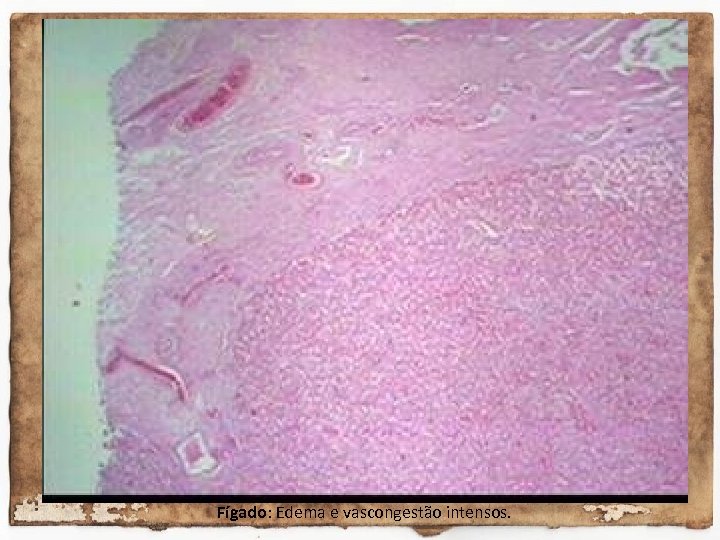 Fígado: Edema e vascongestão intensos. 
