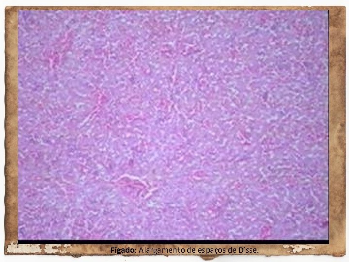 Fígado: Alargamento de espaços de Disse. 