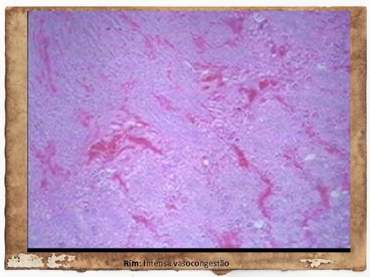 Rim: Intensa vasocongestão 
