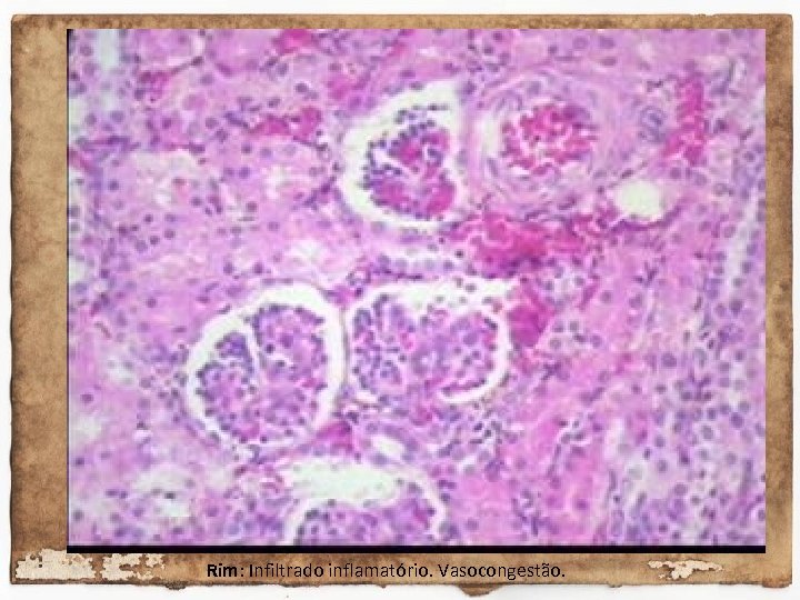 Rim: Infiltrado inflamatório. Vasocongestão. 