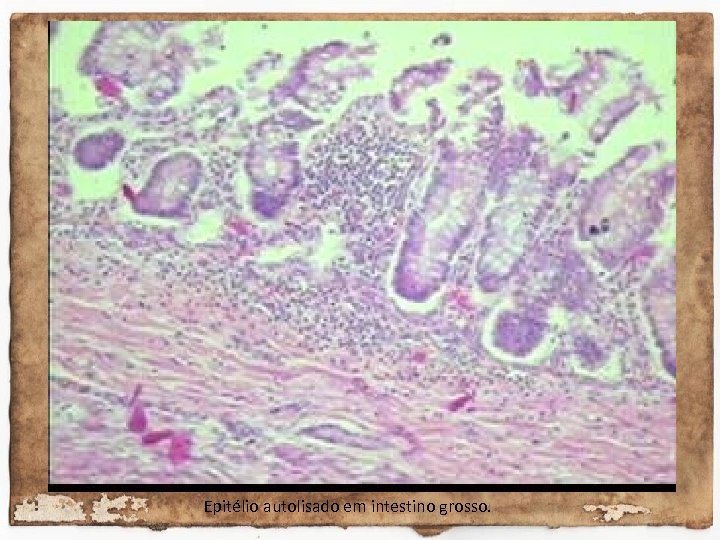 Epitélio autolisado em intestino grosso. 