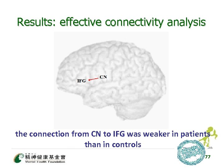 Results: effective connectivity analysis the connection from CN to IFG was weaker in patients