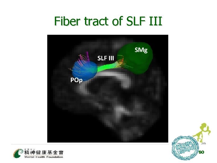 Fiber tract of SLF III 80 