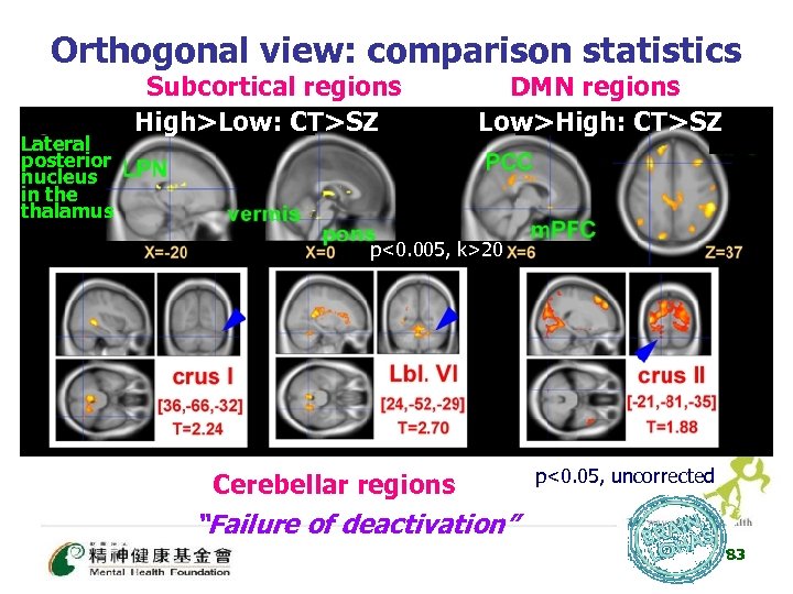 Orthogonal view: comparison statistics Lateral posterior nucleus in the thalamus Subcortical regions High>Low: CT>SZ