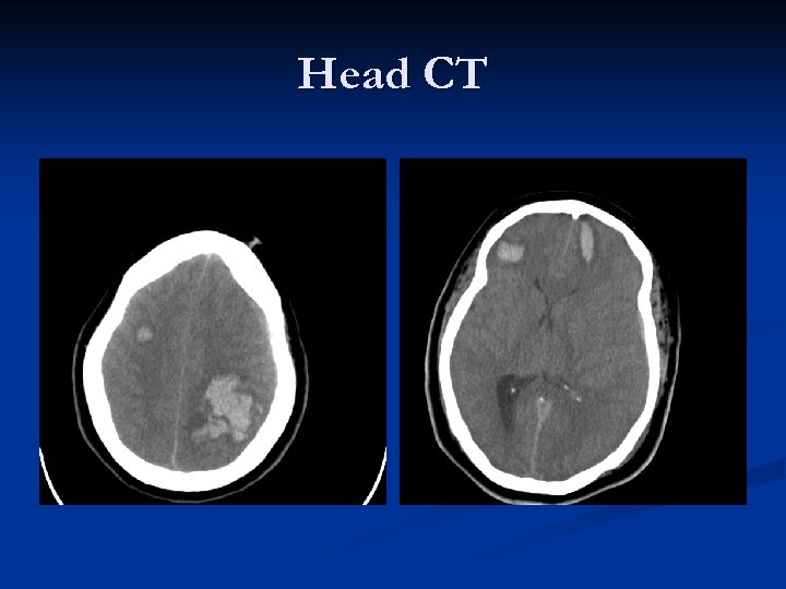 Head CT 