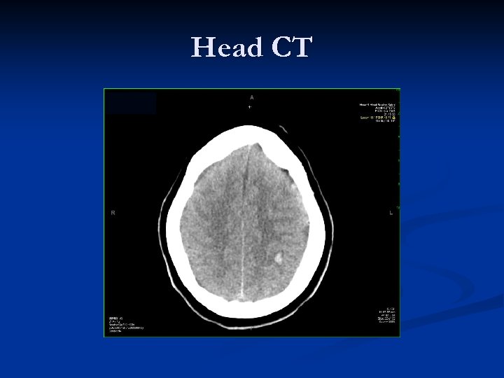 Head CT 
