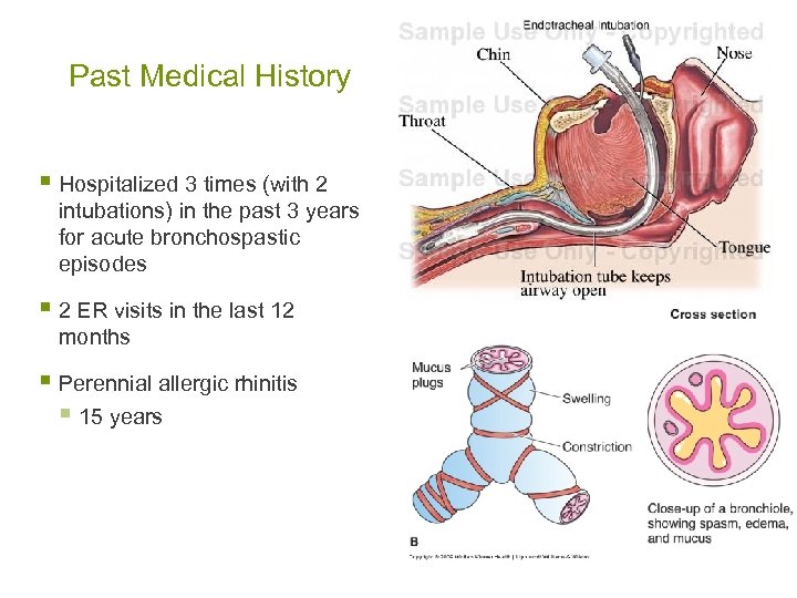 Past Medical History § Hospitalized 3 times (with 2 intubations) in the past 3