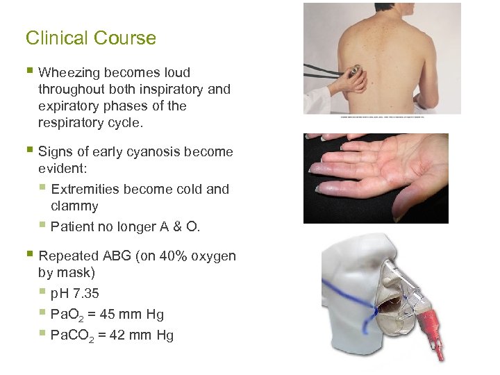 Clinical Course § Wheezing becomes loud throughout both inspiratory and expiratory phases of the