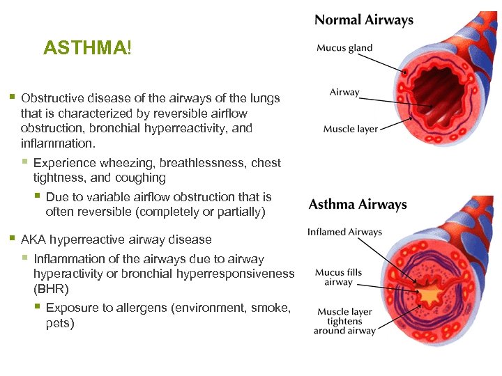 ASTHMA! § Obstructive disease of the airways of the lungs that is characterized by