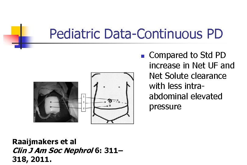 Pediatric Data-Continuous PD n Raaijmakers et al Clin J Am Soc Nephrol 6: 311–