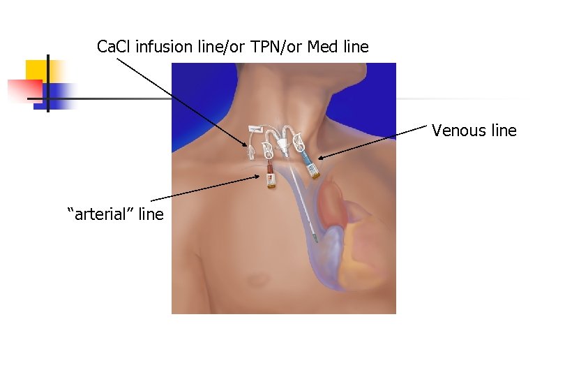 Ca. Cl infusion line/or TPN/or Med line Venous line “arterial” line 