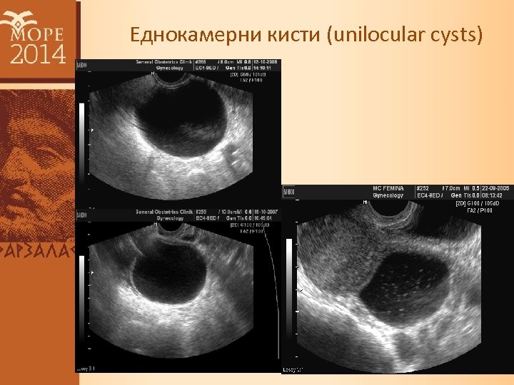 Еднокамерни кисти (unilocular cysts) 