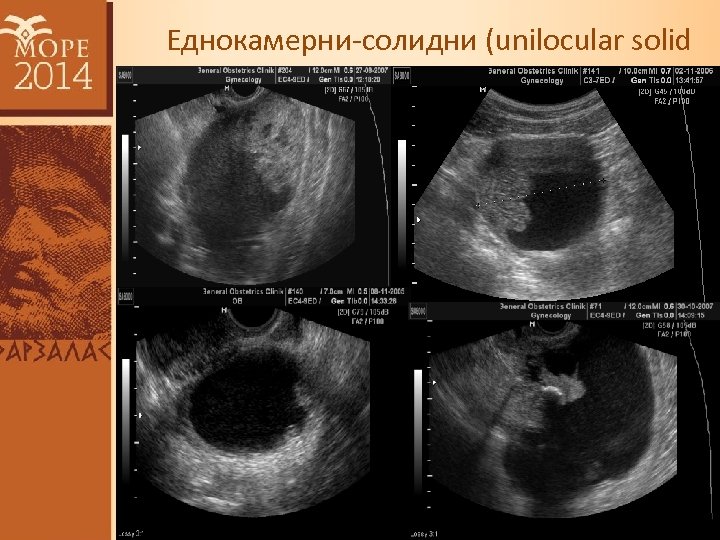 Еднокамерни-солидни (unilocular solid cysts) 