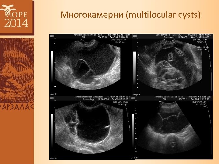 Многокамерни (multilocular cysts) 