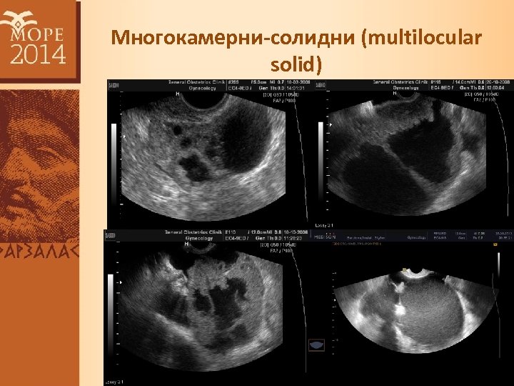 Многокамерни-солидни (multilocular solid) 