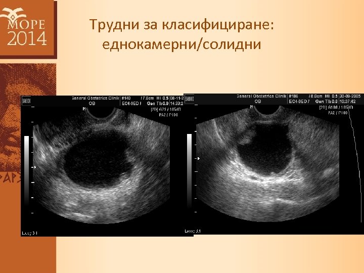 Трудни за класифициране: еднокамерни/солидни 