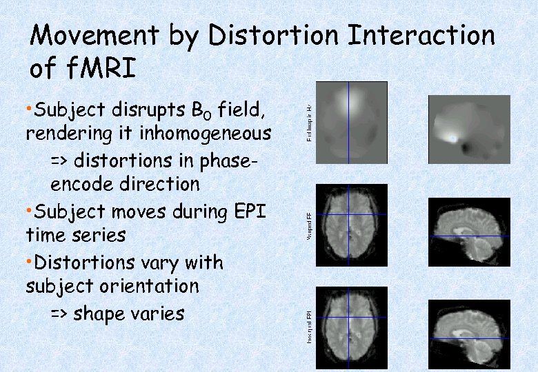 Movement by Distortion Interaction of f. MRI • Subject disrupts B 0 field, rendering