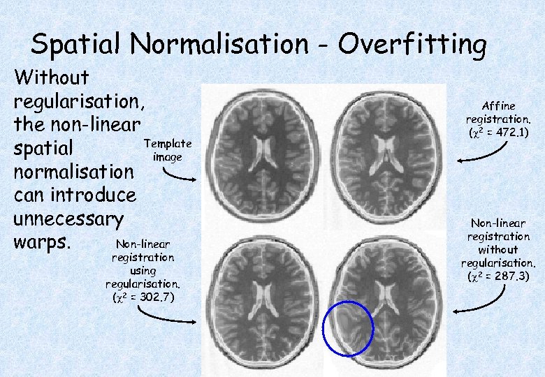 Spatial Normalisation - Overfitting Without regularisation, the non-linear Template spatial image normalisation can introduce