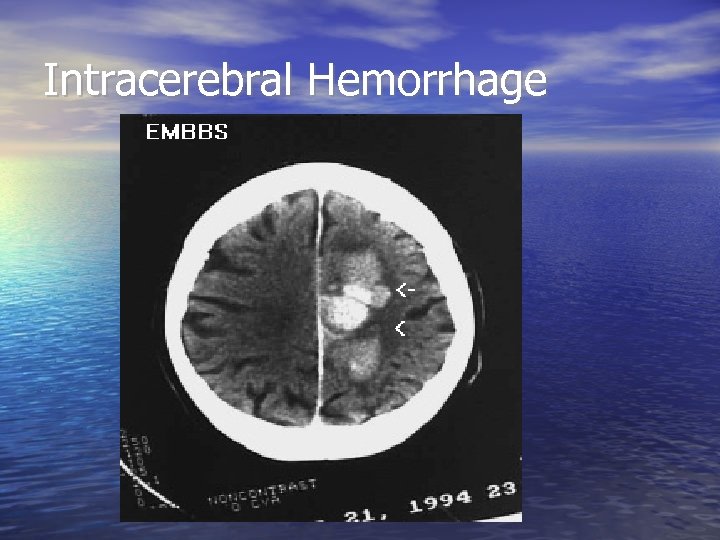 Intracerebral Hemorrhage 