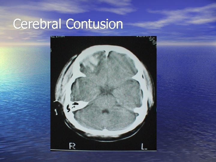 Cerebral Contusion 