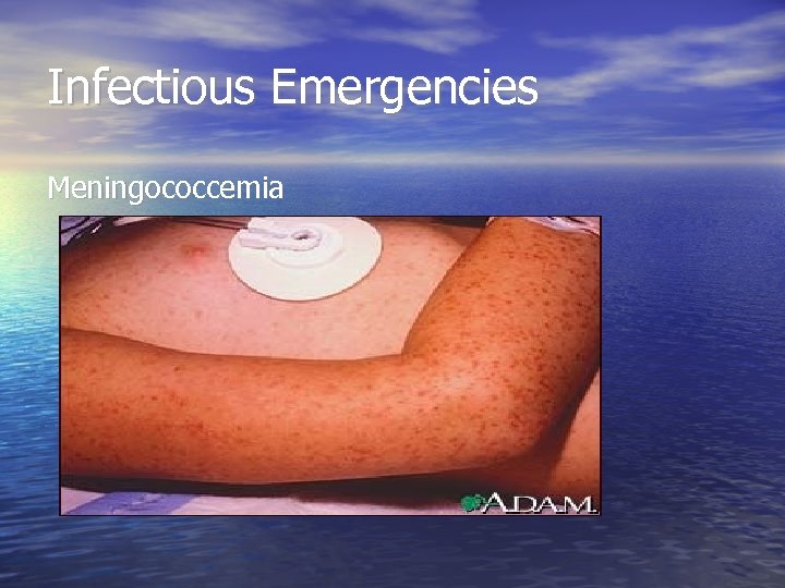 Infectious Emergencies Meningococcemia 