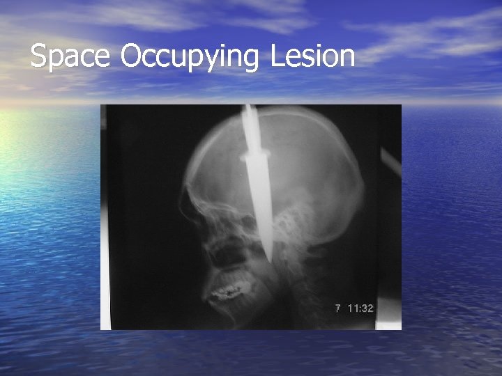 Space Occupying Lesion 