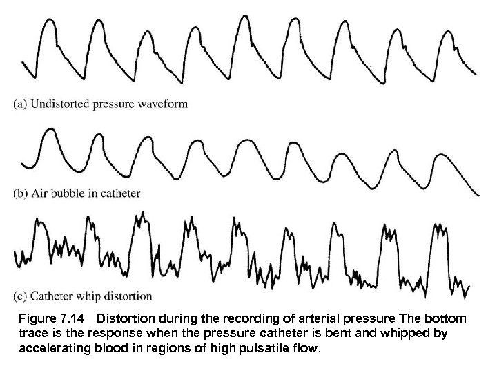 Figure 7. 14 Distortion during the recording of arterial pressure The bottom trace is the