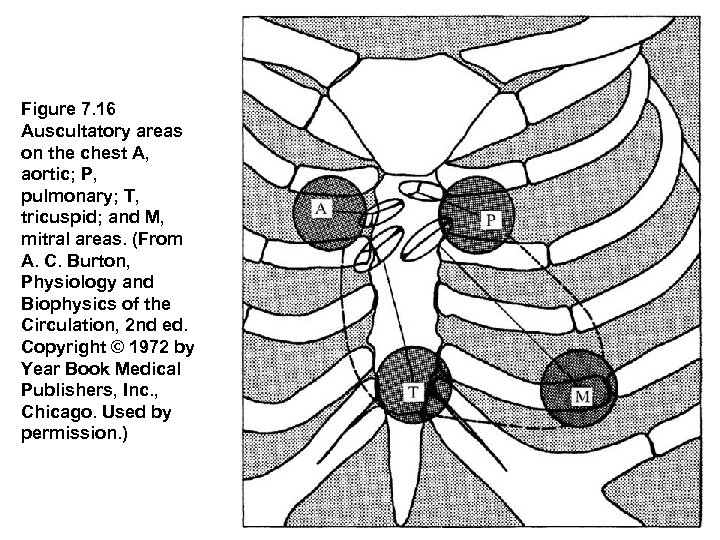 Figure 7. 16  Auscultatory areas on the chest A, aortic; P, pulmonary; T, tricuspid;