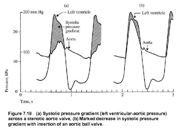Figure 7. 18 (a) Systolic pressure gradient (left ventricular aortic pressure) across a stenotic aortic