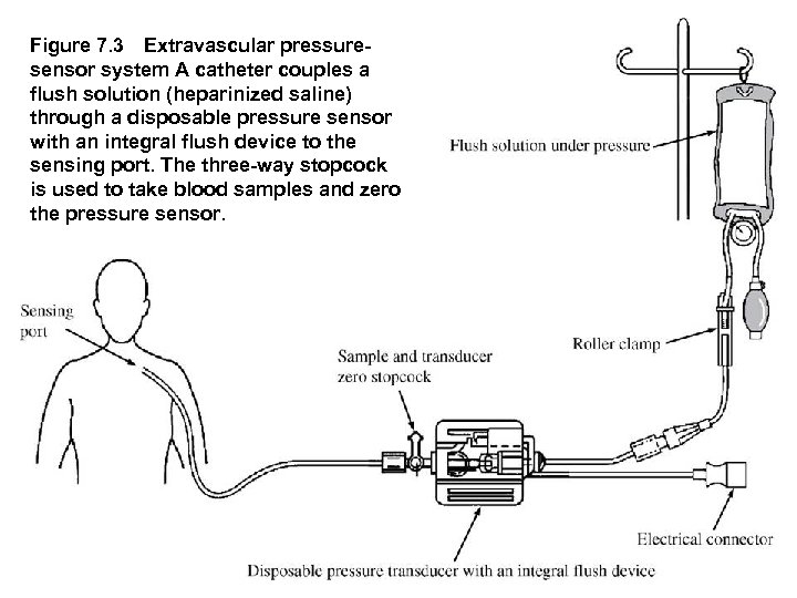Figure 7. 3 Extravascular pressure sensor system A catheter couples a flush solution (heparinized saline)