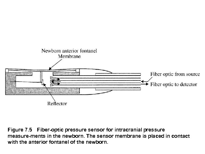 Figure 7. 5 Fiber optic pressure sensor for intracranial pressure measure ments in the newborn.