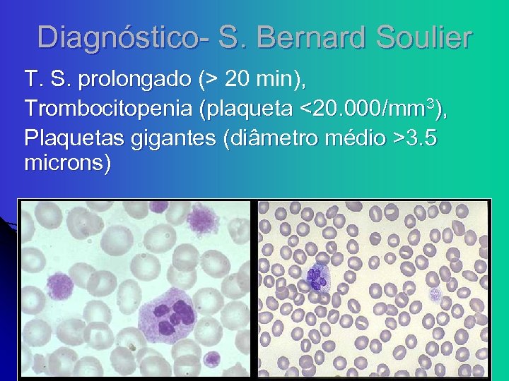 Diagnóstico- S. Bernard Soulier T. S. prolongado (> 20 min), Trombocitopenia (plaqueta <20. 000/mm