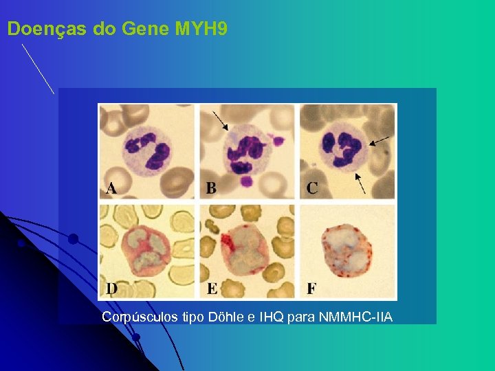 Doenças do Gene MYH 9 Corpúsculos tipo Döhle e IHQ para NMMHC-IIA 